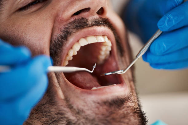 Best Chipped Tooth Repair Near Me  in Helena, AL